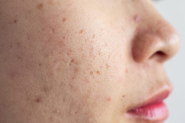 Hyperpigmentation