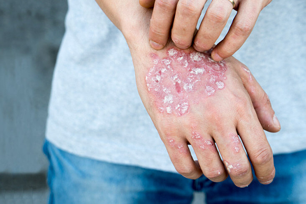 Man scratch oneself, dry flaky skin on hand with psoriasis vulgaris, eczema and other skin conditions like fungus, plaque, rash and patches. Autoimmune genetic disease.
849443346
autoimmune